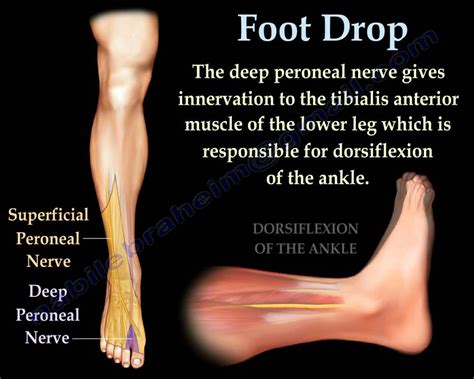 tests for drop foot|unable to dorsiflex foot.